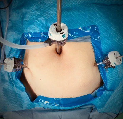 腹腔鏡手術-